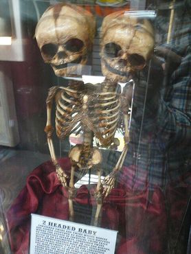 Скелет двухголового ребенка