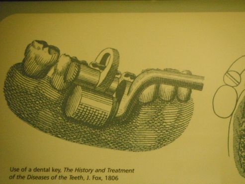 Схема зубного ключа