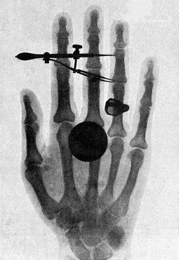 Рентгеновский снимок кисти жены Вильгельма Конрада Рентгена