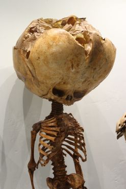 Скелет ребёнка с тяжёлой формой гидроцефалии