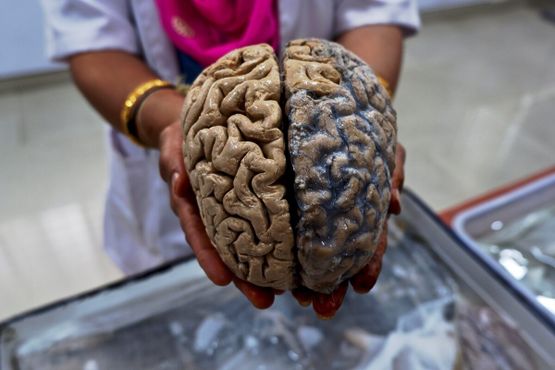 Зафиксированный формалином человеческий мозг