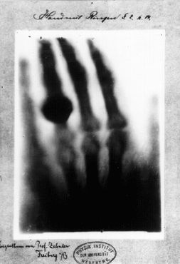Один из первых рентгеновских снимков Вильгельма Рентгена. Кисть левой руки принадлежит его жене Анне Берте Людвиг, 1896 год